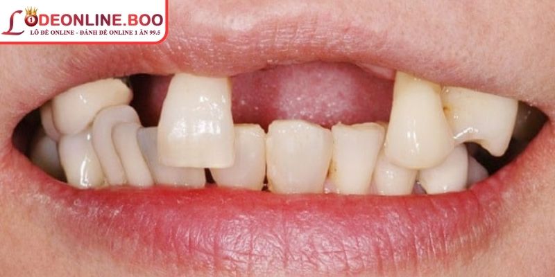 Mơ thấy gãy răng đánh số gì là câu hỏi được nhiều người quan tâm